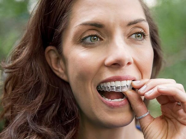 invisalign_frau.jpg